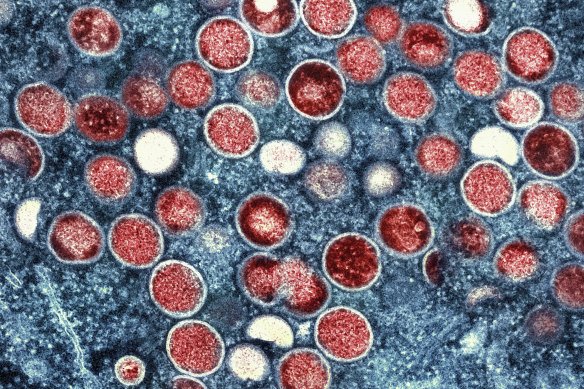 A colorised transmission electron micrograph of monkeypox particles, which are red. 