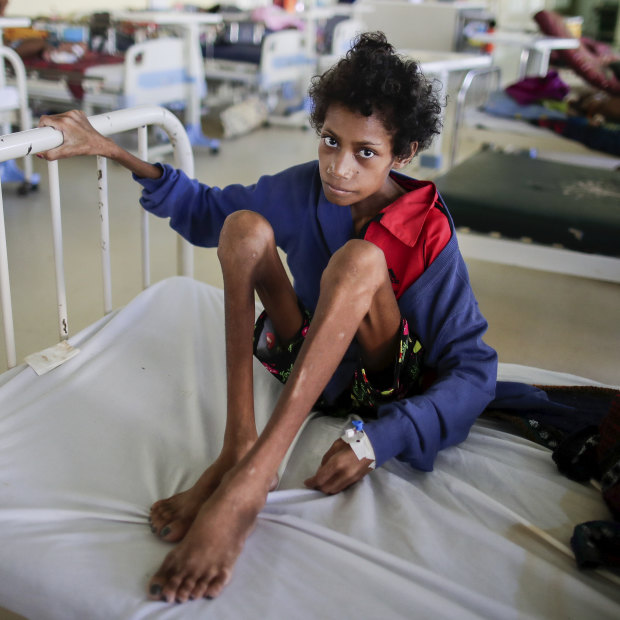 Patricia Oome, 14, a week after being admitted to hospital for severe malnutrition and tuberculosis. 