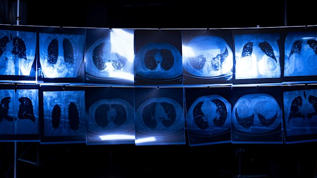 X-rays show the effects of silicosis on victims’ lungs.