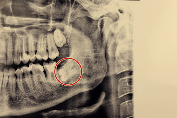 An impacted wisdom tooth. 