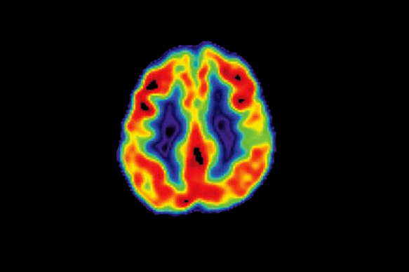 After decades of disappointment, there is finally some good news in dementia research.