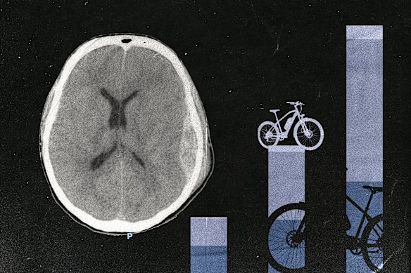 Uma varredura anônima mostra uma lesão cerebral traumática sofrida por um paciente de São Vicente envolvido em um acidente de bicicleta elétrica.