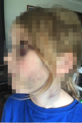 The injuries inflicted on the little girl after she was assaulted by her stepmother with a cricket ball in a sock.
