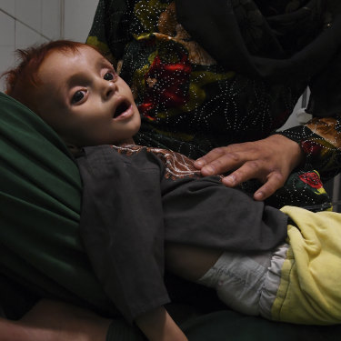 Saber. 10 months old and suffering from severe acute malnutrition, is comforted by his mother Shahr Banoo, 15.