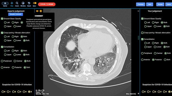 A lung CT showing indications of severe COVID-19.