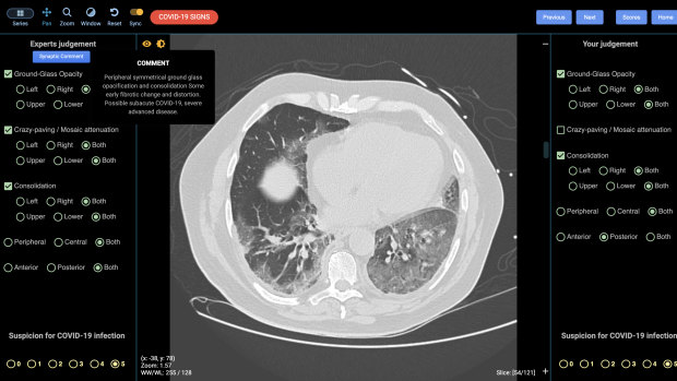 A lung CT showing indications of severe COVID-19.