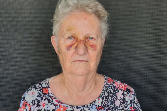 Brisbane resident Robyn Abell was knocked over by someone on an escooter while she was on her way to meet family at the local markets in West End.