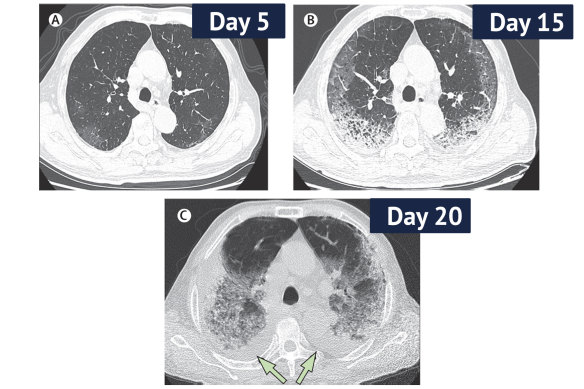 CT scans from a 77-year-old man with COVID-19 in China over 10 days, showing ground-glass opacity of the lungs and lesions. 
The man died 10 days after the final scan.