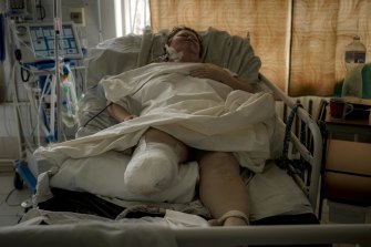 A woman whose leg had to be amputated after she suffered gunshot wounds in a village currently under the control of the Russian military, lies in an intensive care unit at a hospital in Brovary, north of Kyiv, Ukraine.