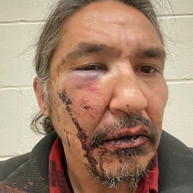 This March 10, 2020 photo provided by Chief Adam, shows the bloodied face of Athabasca Chipewyan First Nation Chief Allan Adam after a confrontation with Royal Canadian Mounted Police. 