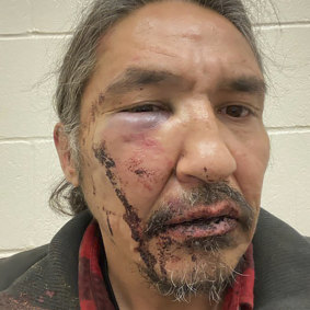 This March 10, 2020 photo provided by Chief Adam, shows the bloodied face of Athabasca Chipewyan First Nation Chief Allan Adam after a confrontation with Royal Canadian Mounted Police. 