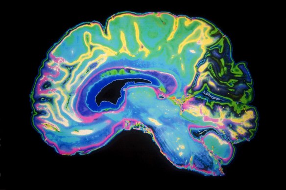 An MRI scan of the human brain. 