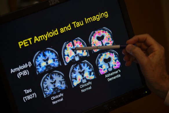 The first new drugs in more than 20 years for the treatment of Alzheimer’s disease are likely to be available here soon.