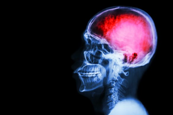 New research has revealed two-thirds of stroke sufferers won’t live beyond a decade after their first incident.