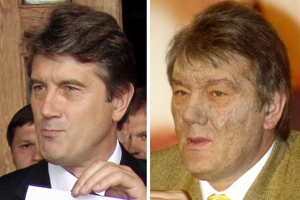 Viktor Yushchenko, Ukraine’s opposition leader and top presidential candidate, before and after suffering a mysterious illness in 2004.