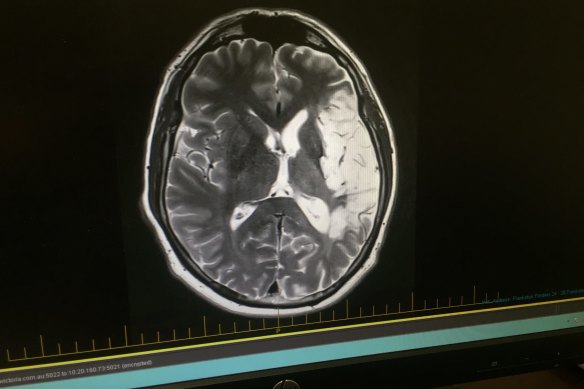 A brain scan shows, in white, the "dead" sections killed off in a stroke.