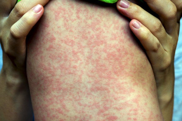 Measles is particularly dangerous for children.