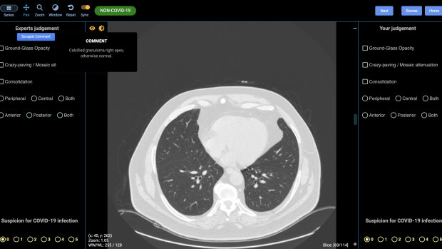A lung CT showing no sign of COVID-19. 