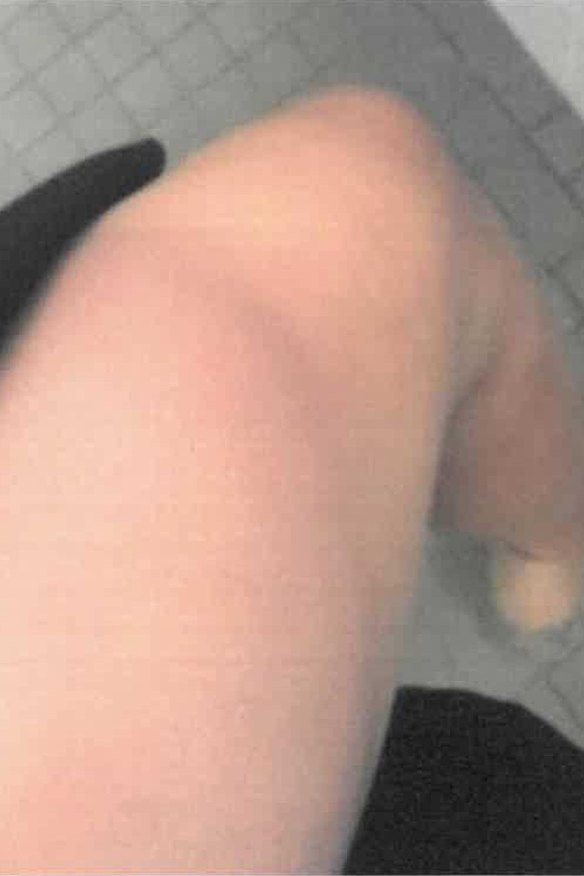 A photo tendered in court in Bruce Lehrmann’s defamation trial of what Brittany Higgins described as a bruise on her leg.