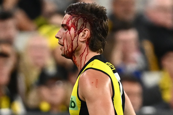 Liam Baker leaves the field bleeding.