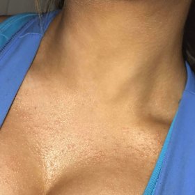 The rash Charlotte Jerrim experienced after having breast implants.