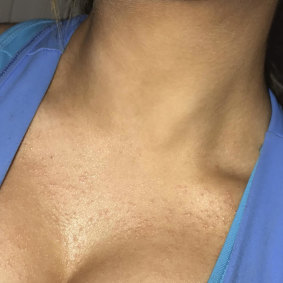 The rash Charlotte Jerrim experienced after having breast implants.