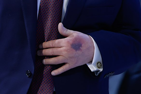 La mano ferita del presidente americano Donald Trump ha fatto parlare di sé a Davos.