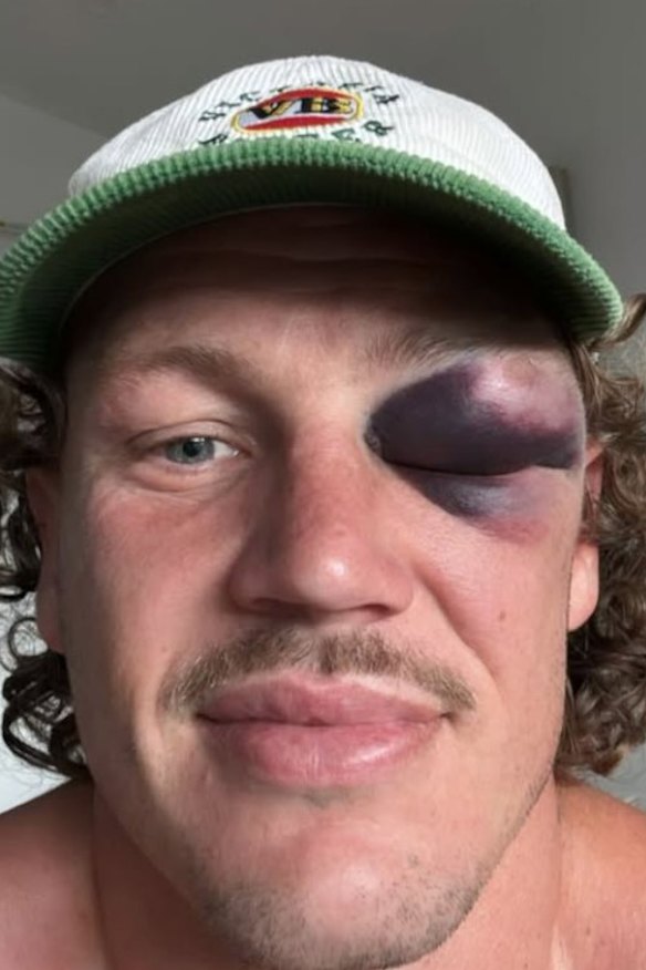 Kurt Mann and that infamous black eye.