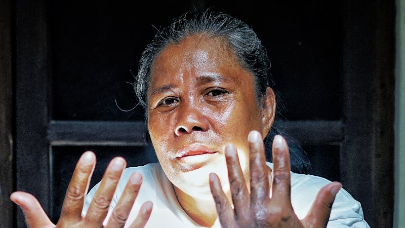 Bali bombing patients caught up in Indonesia’s DOGE-style budget cuts