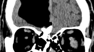 A scan of the man's skull shows the air pocket (the black space) where part of his brain should be.