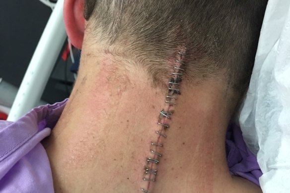 Ollie Bierhoff's neck after his surgery.