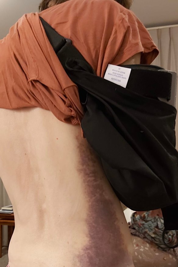 Bruising to Julia Miller’s side two weeks after she was hit by a hire scooter in Melbourne. 