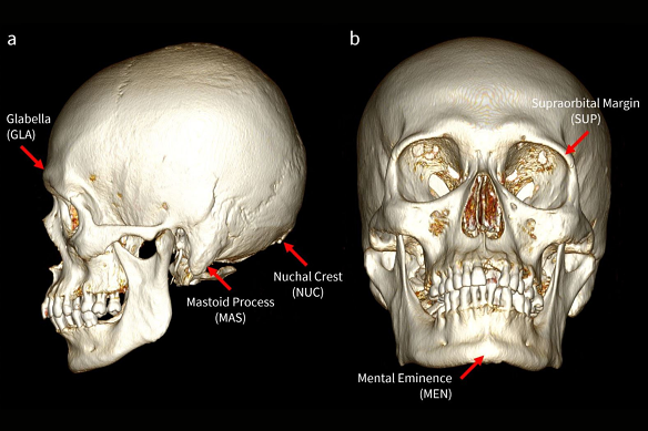 The five structures of the skull used in the Walker method of identifying the sex of skulls.