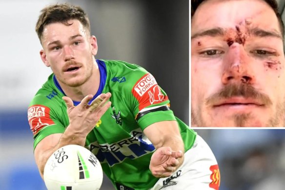 Canberra Raiders star Tom Starling and the injuries he sustained.