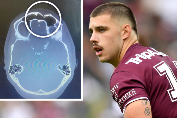 A scan showing the extent of Zac Saddler’s injury after his skull caved in.