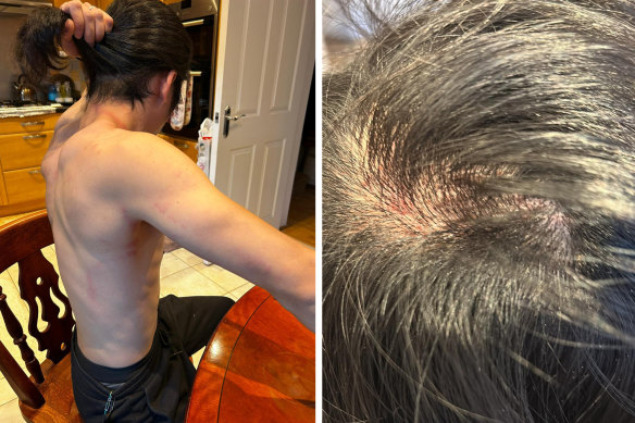 Hong Kong protestor Bob says hair was ripped from his scalp when he was beaten on the grounds of the Chinese consulate in Manchester, England, on Sunday, 16 October, 2022.