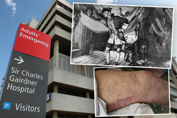 Doctors fear the cost of living could fuel a resurgence of scurvy after a Perth man was diagnosed.