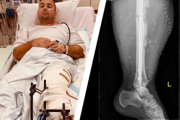 Bill Springett-Kelly in St Vincent's Hospital and an X-ray of his heavily swollen left leg, complete with titanium rods and screws, after the collision.