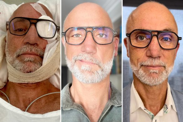 Graham Kittle before, during and after his facial reconstruction following a surfing incident.