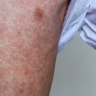 Measles outbreak takes hold in Brisbane, 23 cases now recorded