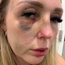 Chloe Wright was assaulted by her ex-partner, who has since been granted bail as he awaits sentencing.