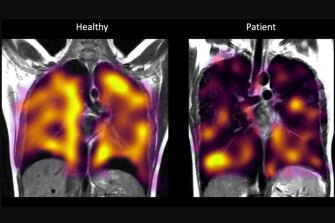 The universities of Oxford, Sheffield, Cardiff and Manchester have been collaborating to try new scanning techniques to pick up less obvious signs of lung damage in long COVID patients (right).