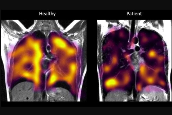 The universities of Oxford, Sheffield, Cardiff and Manchester have been collaborating to try new scanning techniques to pick up less obvious signs of lung damage in long COVID patients (right).