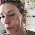 One of Glanville’s diagnoses is a facial mite called Demodex dermatitis.