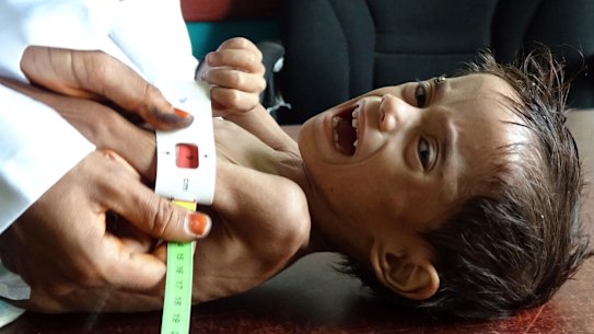 Ahmed Abdo Salem, a two-year-old Yemeni displaced by the conflict and weighing only five kilograms is measured at a health clinic in Yemen’s war-ravaged western Hodeida province.