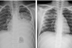 Collection of radiographs show the effects of mycoplasma pneumoniae on the lungs of children. Source: Cho et al (2019)