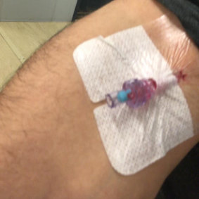 An intravenous cannula was left in his arm.
