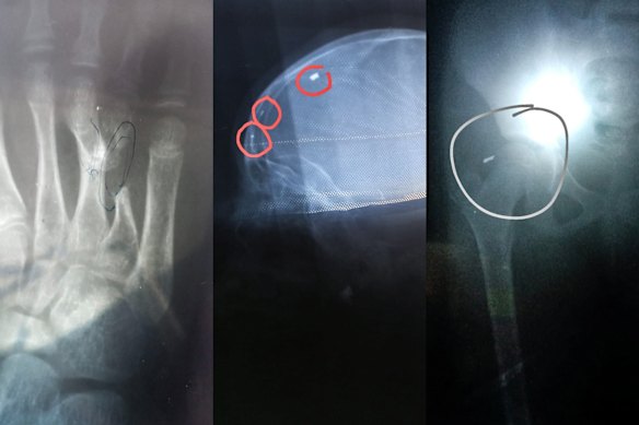 X-rays show the medical condition of Hodan Abby’s nine-year-old daughter.
