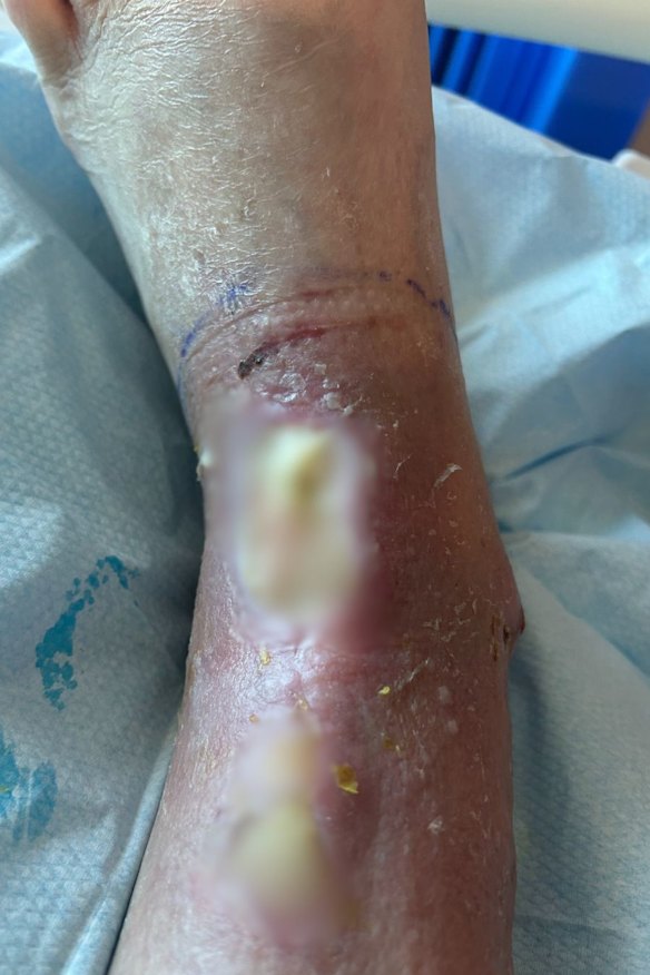 Wayne Rance’s injury after it had become infected and its coverings were removed. The image has been blurred.