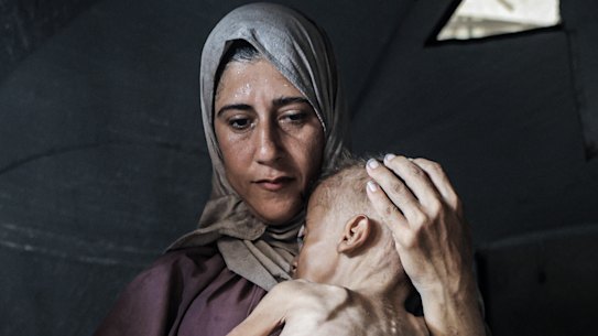 Muhammad Zakariya Ayyoub al-Matouq, 1, is facing life-threatening malnutrition.